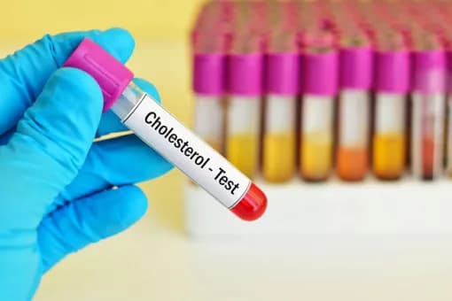 Cholesterol 200 czy to dużo? Sprawdź, co to oznacza dla zdrowia Cholesterol 200 czy to dużo? Sprawdź, co to oznacza dla zdrowia