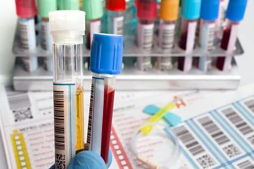 Cholesterol czy na czczo? Co musisz wiedzieć przed badaniem krwi Cholesterol czy na czczo? Co musisz wiedzieć przed badaniem krwi